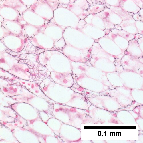 Steatohepatitis. Brunt necroinflammatory grade 2. Brunt fibrosis stage 2.