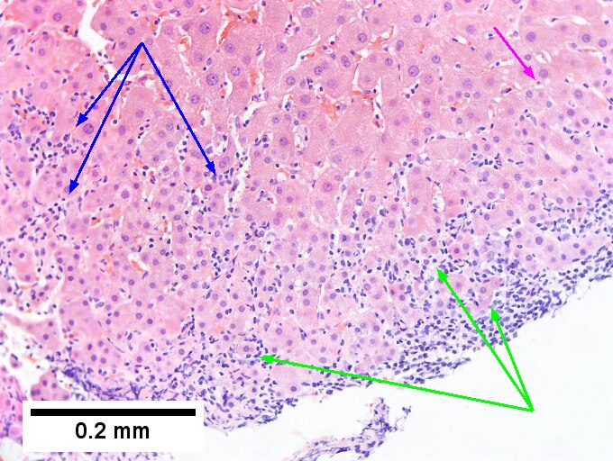 Hepatitis B virus. Metavir activity index 3 {PMN 2 LN 2]. Metavir fibrosis stage 4 (advanced fibrosis/cirrhosis).