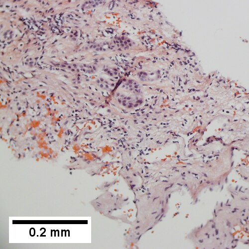 Tortuous bile ducts/ductules, not to be considered generalized in presence of mass (200X).