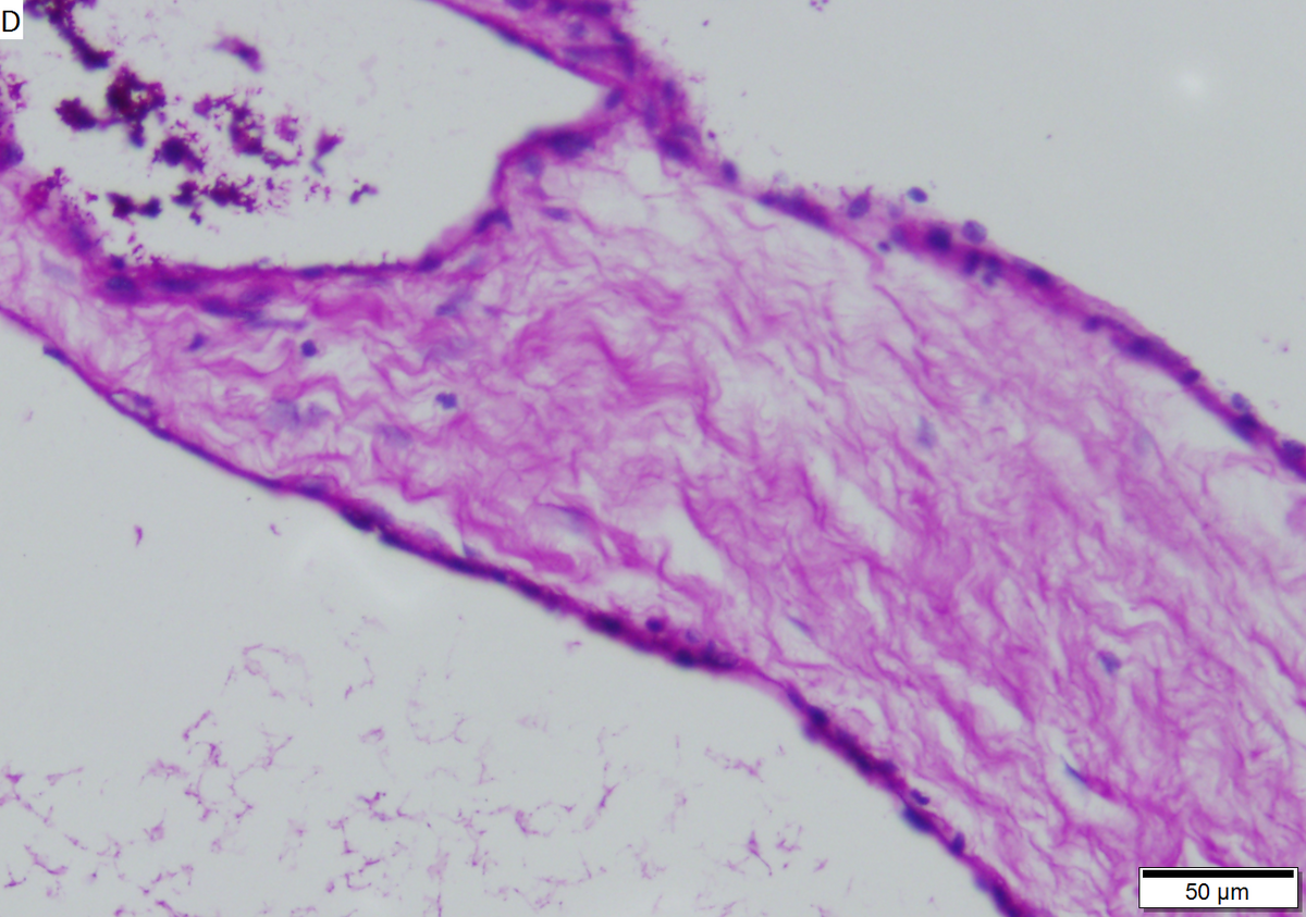 Microcystic serous cystadenoma of pancreas