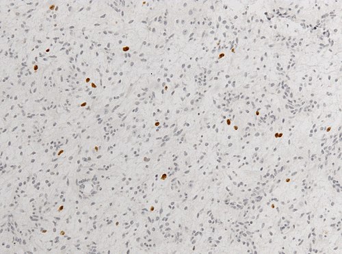 Neuropathology case V 07.jpg