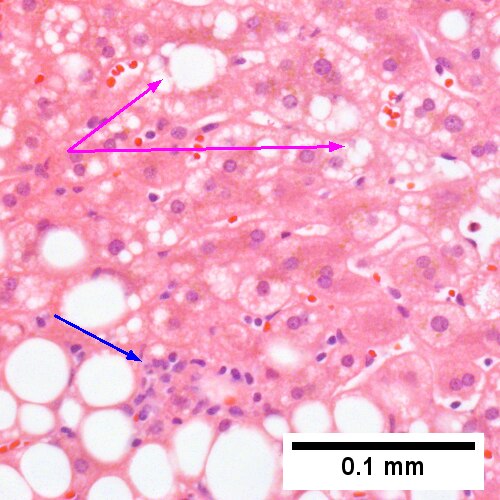 Steatohepatitis. Brunt necroinflammatory grade 1. Brunt fibrosis stage 1.