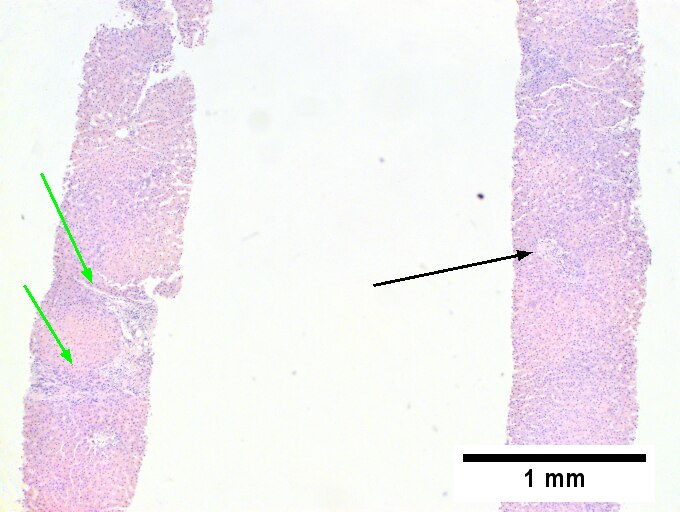 Primary sclerosing cholangitis in patient with history of ulcerative colitis.