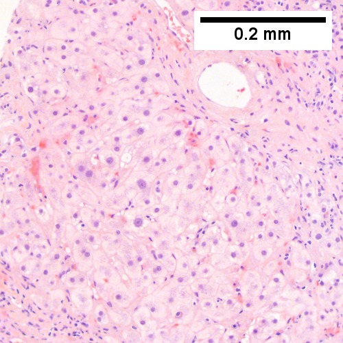 Hepatocellular carcinoma with fragments of liver afflicted by steatosis & with regenerative, benign fragments.