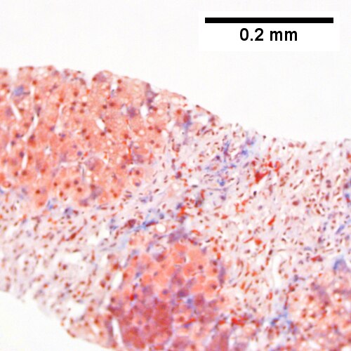 Submassive hepatic necrosis.