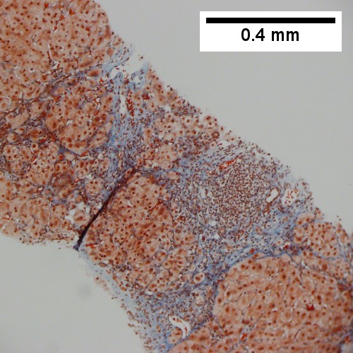 Trichrome with bridging, no nodules or extensive bridging on slides as a whole (100X).