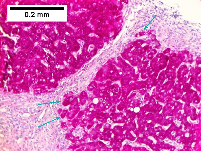 Hepatitis C virus. Metavir activity index 3 (PMN 2, LN 2). Metavir stage 4 (cirrhosis, definite by old criteria).