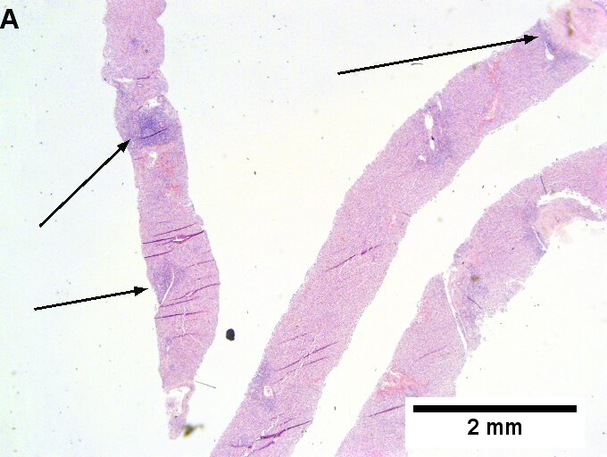 Drug induced liver injury in a young adult man