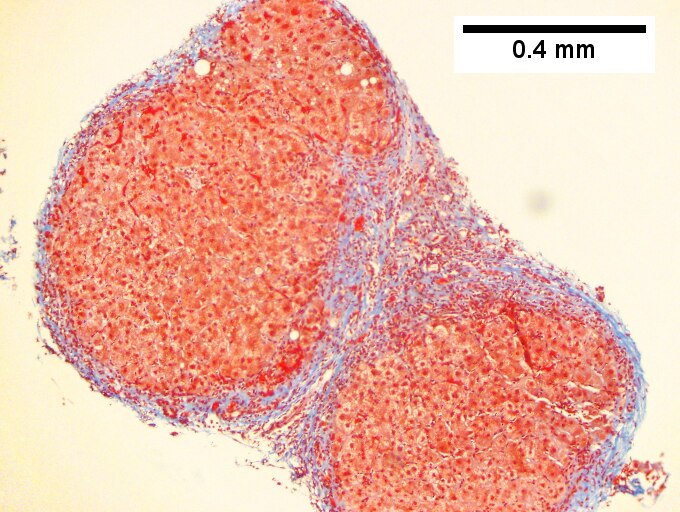 Hepatitis C virus. Metavir activity index 3 (PMN 2, LN 2). Metavir stage 4 (cirrhosis, definite by old criteria).