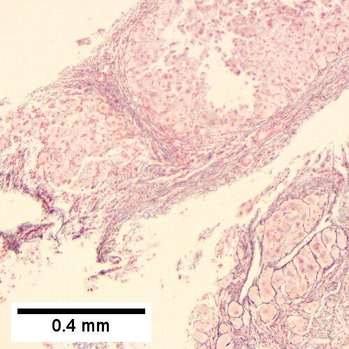 Alpha 1 Antitrypsin deficiency with cirrhosis