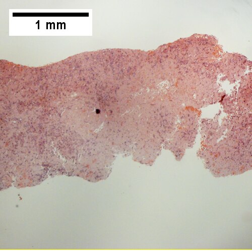 Amorphous material replaces hepatic parenchyma [4X]