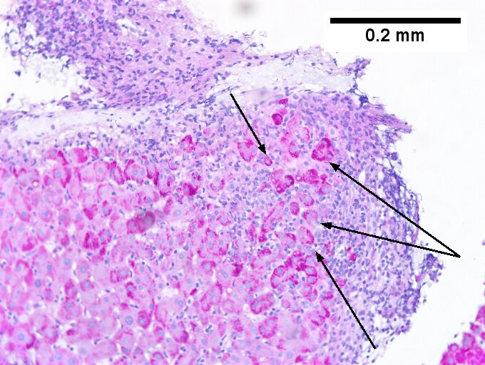 Hepatitis B virus. Metavir activity index 3 {PMN 2 LN 2]. Metavir fibrosis stage 4 (advanced fibrosis/cirrhosis).