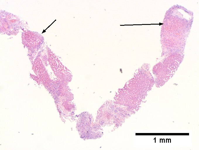 Cirrhosis in an alcoholic.