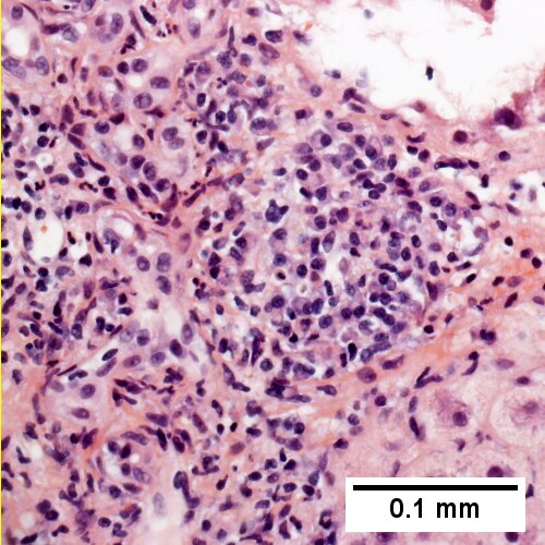 Abundant plasma cells seen at higher power (400X).