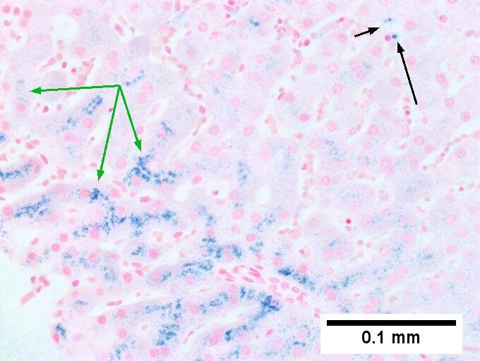 Hemocrhomatosis with DILI canalicular cholestasis with mild hepatocyte injury in the form of regeneration.