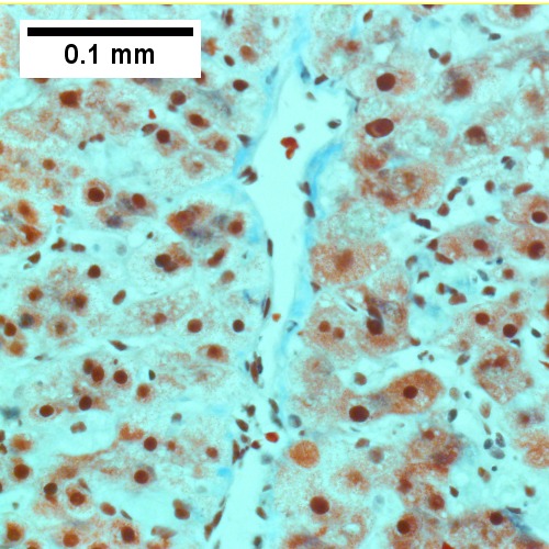 Trichrome shows fibrosis about central vein (400X).