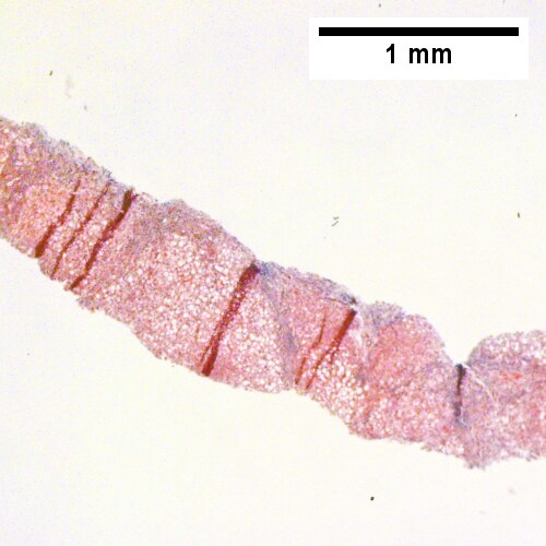 Inflamed bands cross hepatocytes with steatosis (Row 1 Left 40X).