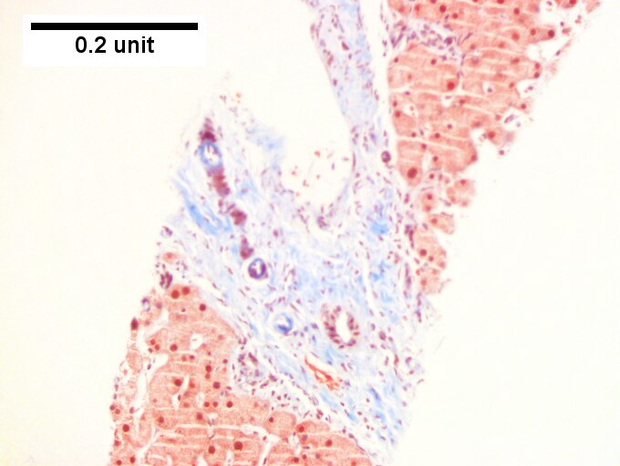 Hepatic sarcoidosis in a patient with previously known sarcoidosis.