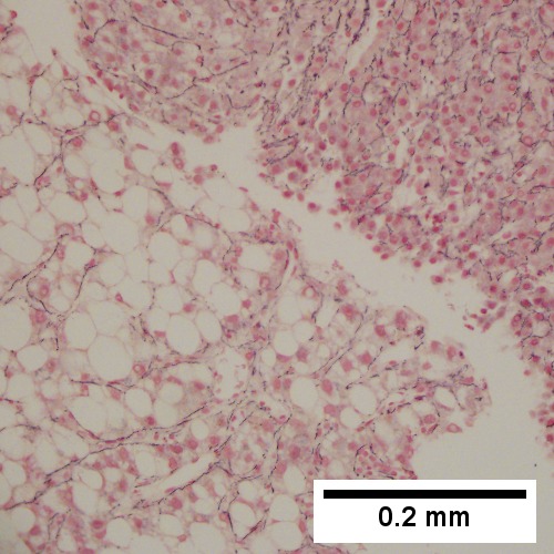 Hepatocellular carcinoma with fragments of liver afflicted by steatosis & with regenerative, benign fragments.