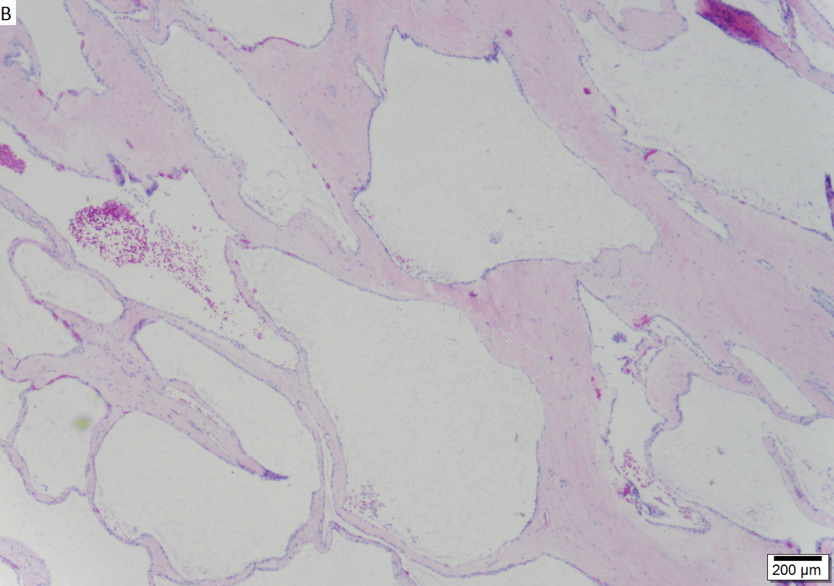 Microcystic serous cystadenoma of pancreas