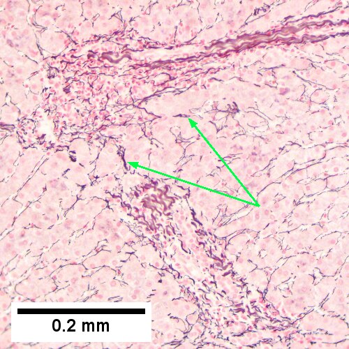 Hepatitis C virus. Metavir Activity Index 1 (PMN 0 LN 1).