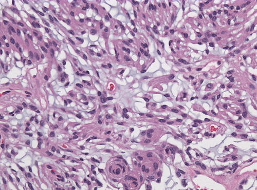 Neuropathology case XI 03.jpg