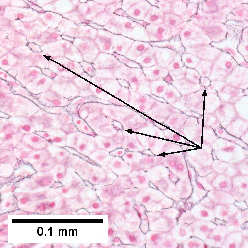 Steatohepatitis. Brunt necroinflammatory grade 2. Brunt fibrosis stage 2.