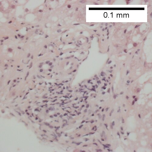 Triad with mild chronic inflammation without interface hepatitis (400X).