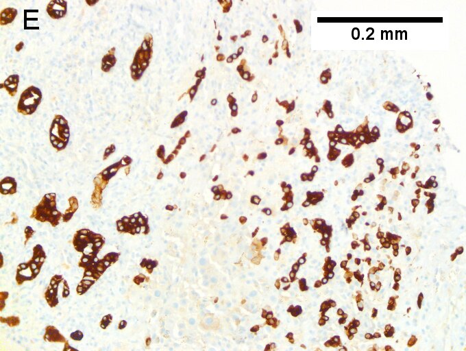 Cholangiocarcinoma with associated abscess