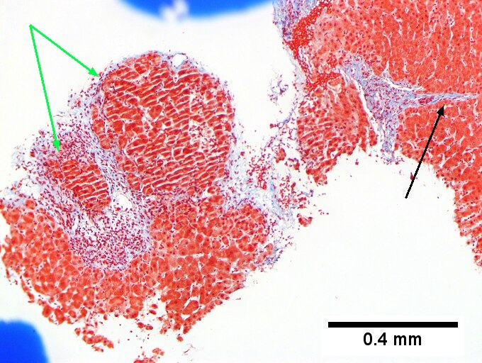 Hepatitis B virus. Metavir activity index 3 {PMN 2 LN 2]. Metavir fibrosis stage 4 (advanced fibrosis/cirrhosis).