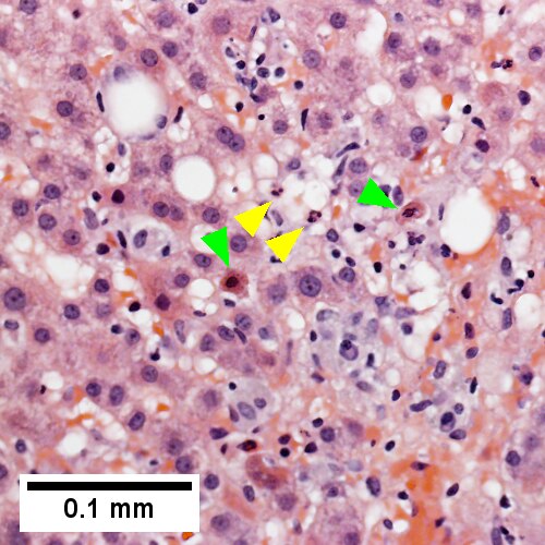 Neutrophils about ballooned hepatocyte (satellitosis) [yellow arrowheads]. Councilman bodies [green arrowheads] (400X).