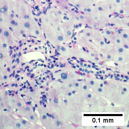 PAS with diastase shows portal triads with mild edema and chronic inflammation, without tortuous bile duct (400X).