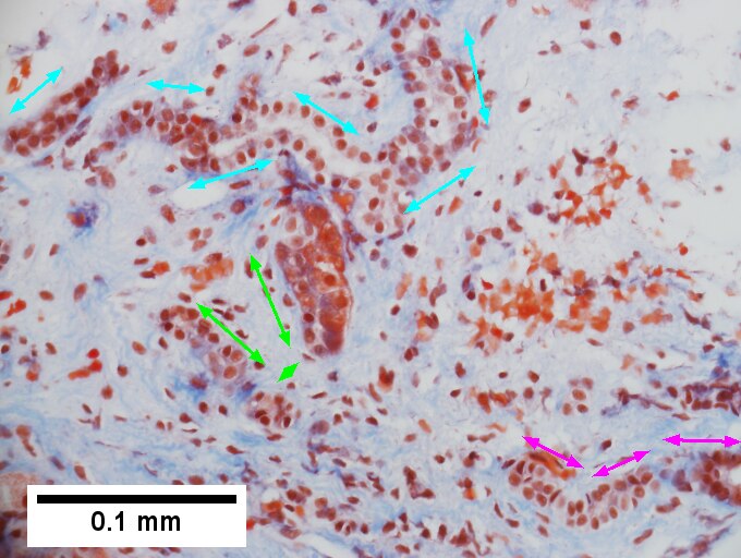 Cirrhosis in an alcoholic.