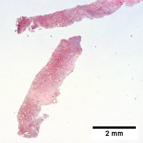 A process replaces most of the liver parenchyma (20X).