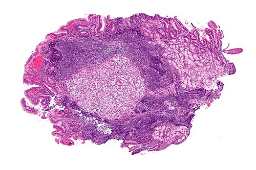 Paraganglioma - low mag.jpg