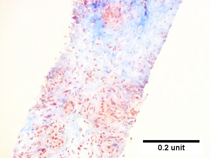 Hepatic sarcoidosis in a patient with previously known sarcoidosis.