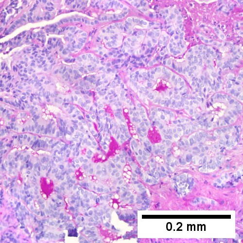 Cholangiocarcinoma, intrahepatic, large duct type.