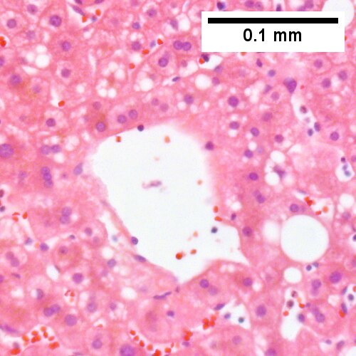 Steatohepatitis. Brunt necroinflammatory grade 1. Brunt fibrosis stage 1.