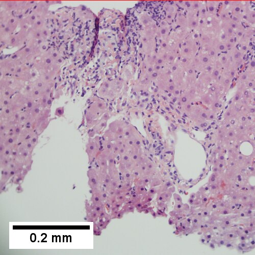 A triad lacks a bile duct (200X).