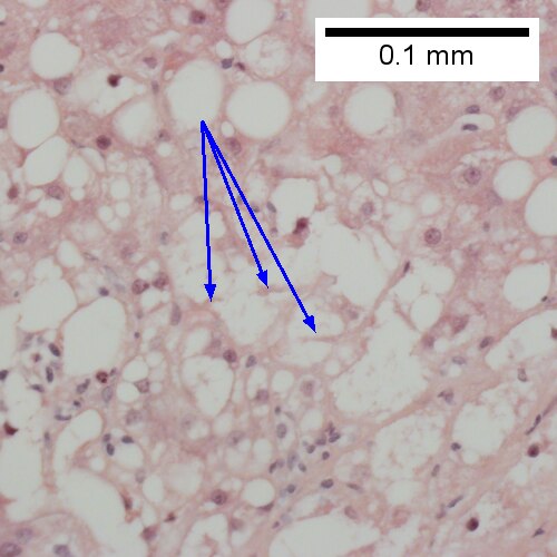 Ballooning degeneration, with cytoplasmic tufts (arrows) (400X).