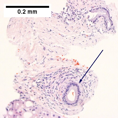 An isolated septal duct with concentric fibrosis (arrow) should not result in a diagnosis of primary sclerosing cholangitis. The patient had a normal bilirubin. (Row 1 Right 200X).