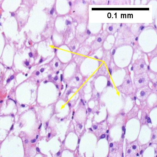 Steatohepatitis. Brunt necroinflammatory grade 2. Brunt fibrosis stage 2.