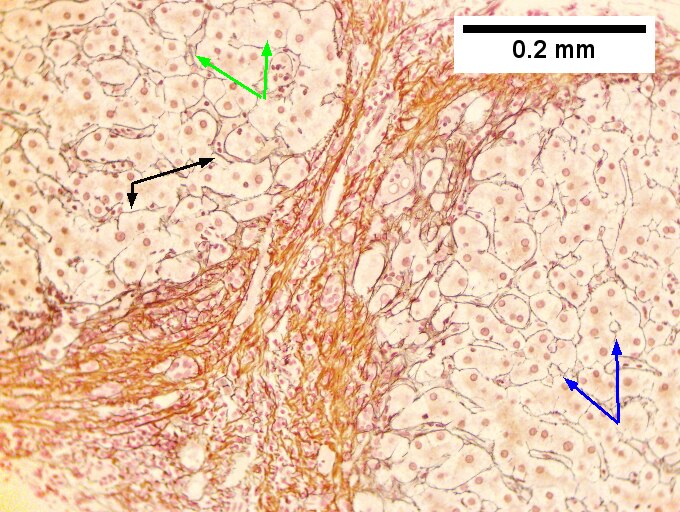 Hepatitis C virus. Metavir activity index 3 (PMN 2, LN 2). Metavir stage 4 (cirrhosis, definite by old criteria).