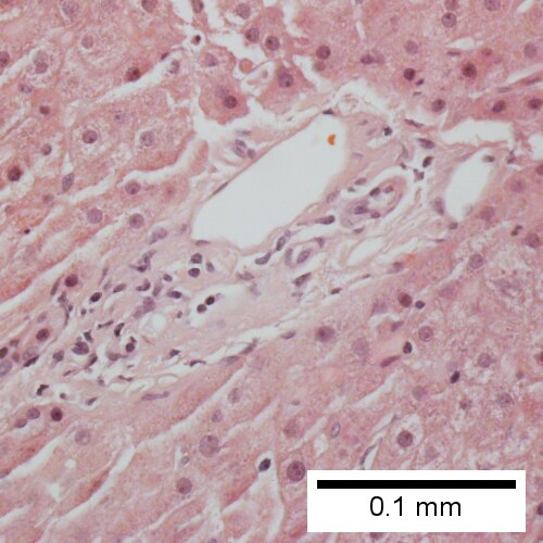 Triad missing interlobular bile duct (Row 2 Right 400X).