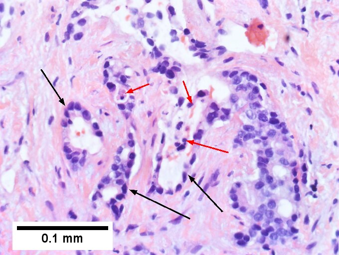 Cholangiocarcinoma, intrahepatic, small duct type.