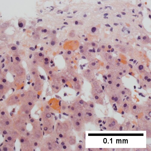 Thrombi in sinusoids; glycogenated nuclei likely reflect patient’s diabetes mellitus (400X).