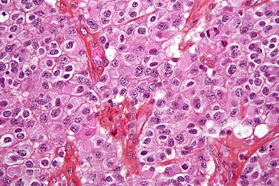 Oligodendroglioma1 high mag.jpg