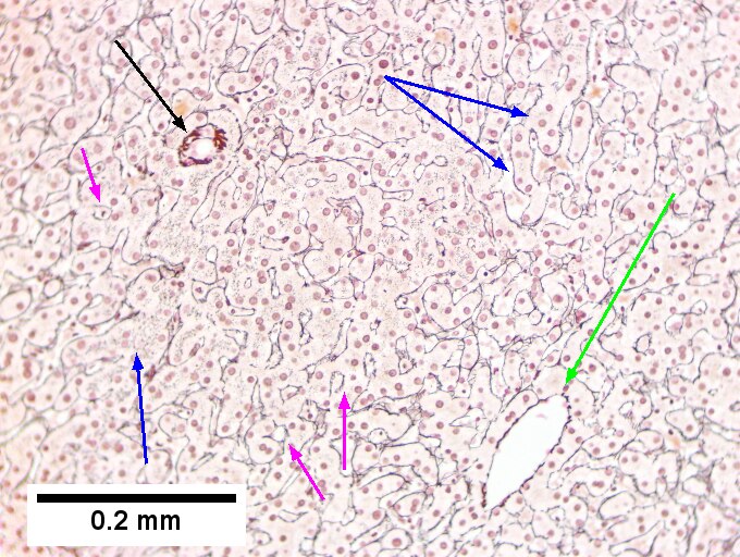 Hemocrhomatosis with DILI canalicular cholestasis with mild hepatocyte injury in the form of regeneration.