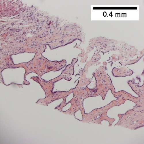 Bizarre, ramifying tubules with dilatations (100X).