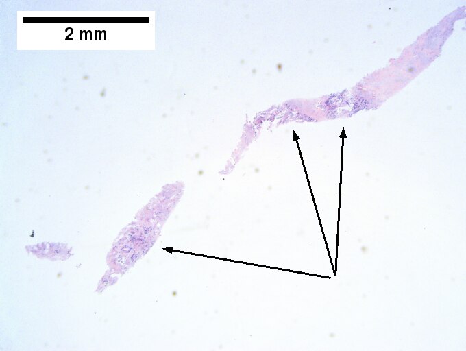 Cholangiocarcinoma, intrahepatic, small duct type.